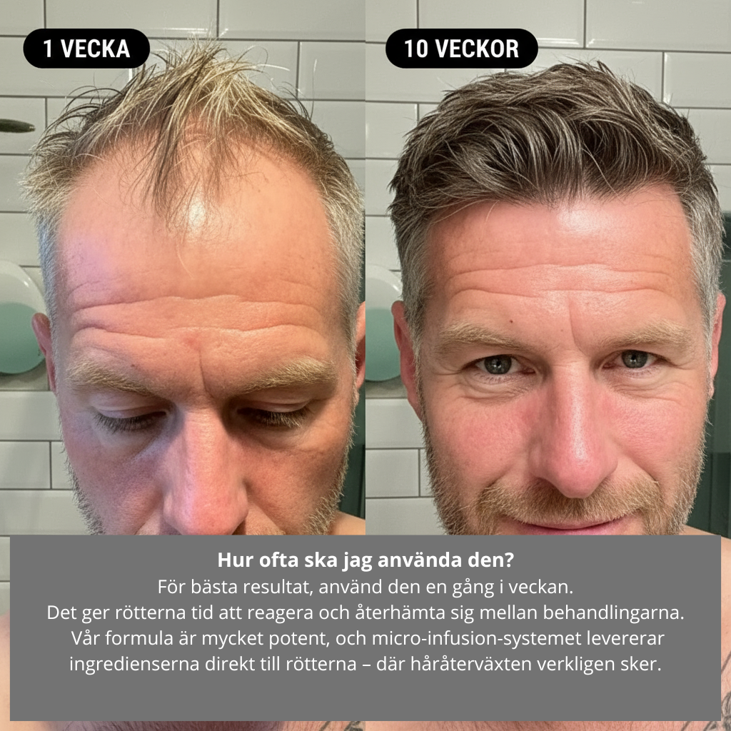 AlphaRevive™ Hårväxtsystem