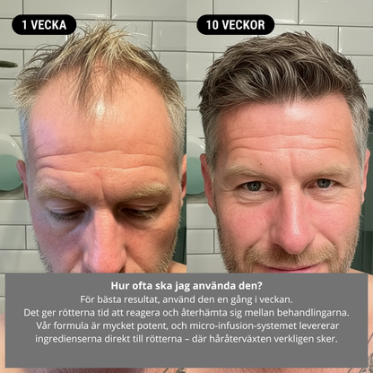 AlphaRevive™ Hårväxtsystem